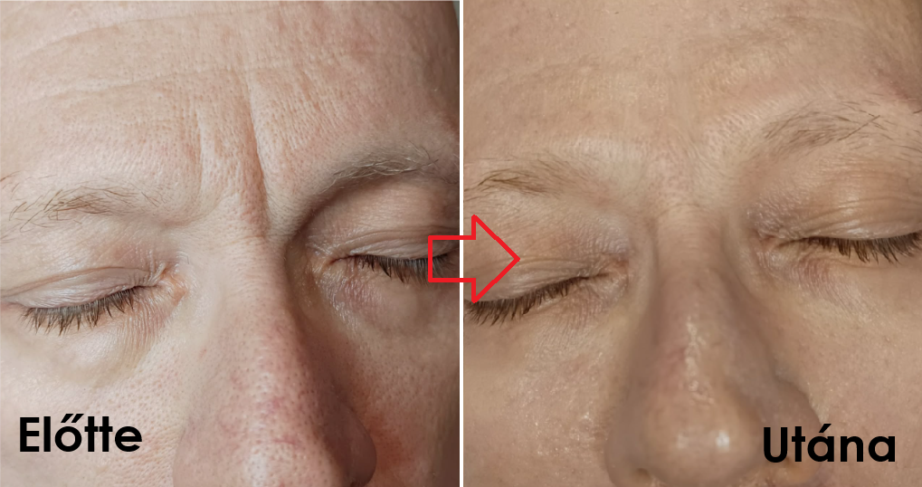 Ragyogást fokozó AHA savas peeling kezelés